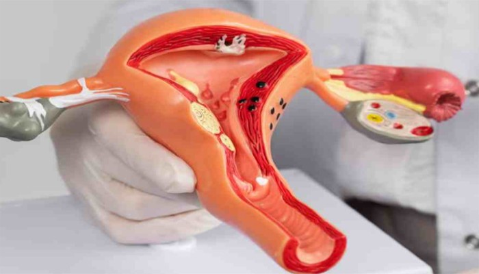 জরায়ুতে ফাইব্রয়েড থাকলে গর্ভপাতের ঝুঁকি বাড়ে, ভিটামিন ডি-এর ঘাটতিও কি এর কারণ? জরায়ুতে ফাইব্রয়েড থাকলে গর্ভপাতের ঝুঁকি বাড়ে, ভিটামিন ডি-এর ঘাটতিও কি এর কারণ?