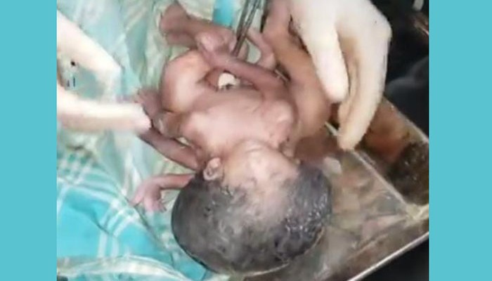 নাটোরে চার হাত-পা ও দুই মাথা নিয়ে এক শিশুর জন্ম নাটোরে চার হাত-পা ও দুই মাথা নিয়ে এক শিশুর জন্ম