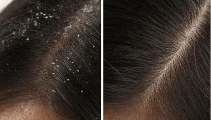 নিম ও তুলসীর কম্বোতেই দূর হবে খুশকির সমস্যা নিম ও তুলসীর কম্বোতেই দূর হবে খুশকির সমস্যা