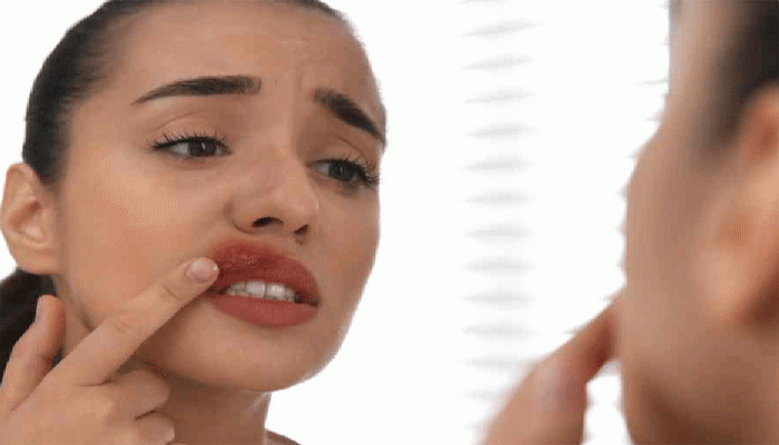 মুখের ঘা ৫ উপায় মেনে চললেই মিলবে স্বস্তি, কমবে জ্বালা মুখের ঘা ৫ উপায় মেনে চললেই মিলবে স্বস্তি, কমবে জ্বালা