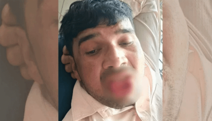 সাবেক প্রেমিকাকে চুমু, কামড়ে ছিন্ন প্রেমিকের জিহ্বা