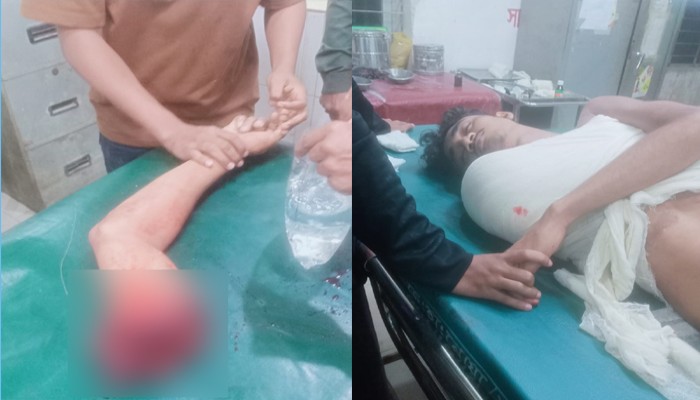নোয়াখালীতে ট্রাকের ধাক্কায় তরুণের হাত বিচ্ছিন্ন