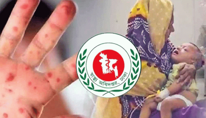 হাম ও হামের উপসর্গ নিয়ে আরও ৯ শিশুর মৃত্যু